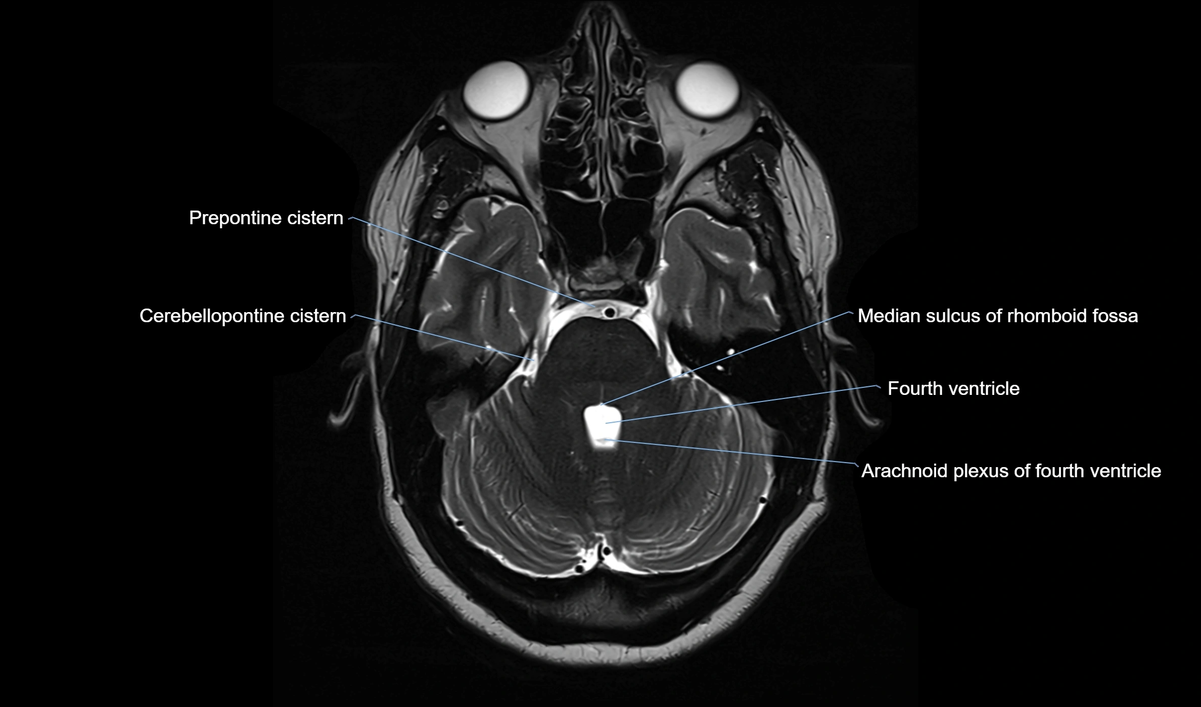 Brain cisterns  and ventricles  axial anatomy 3T MRI image-img-00001-00015.webp